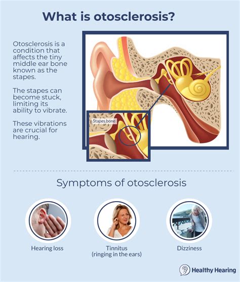 Otosclerosis Hearing Health Hearing Loss Nursing School Survival
