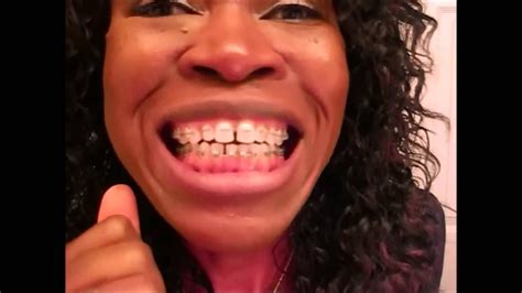 To do this, a small elastic rubber band is placed around the affected teeth. {#117} FIRST DAY WITH BRACES ON ~ AND ~ LAST DAY WITH ...