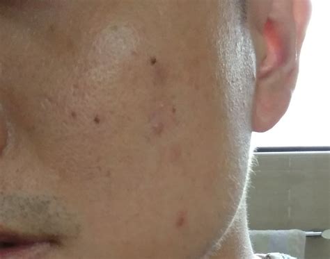 Black Dots On The Face Why Appear And How To Remove Them Vrogue