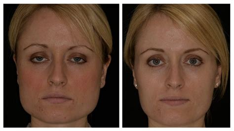 Facial Slimming Drbk Cosmetic Dentist And Aesthetics Clinic In Reading
