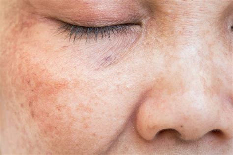 The Facts Behind Skin Discoloration Yeg Fitness