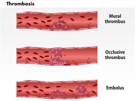 0814 Types Of Thrombosis Medical Images For Powerpoint Presentation