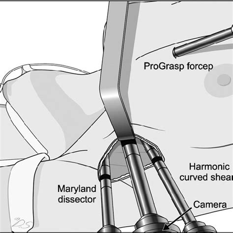 Single Incision Robotic Thyroidectomy A All Four Robotic Instruments