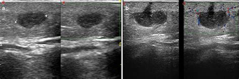 Figure 10 From A Bump What To Do Next Ultrasound Imaging Of