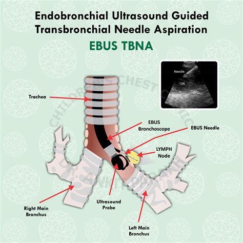 Endobronchial Ultrasound Guided Transbronchial Needle Aspiration Dr