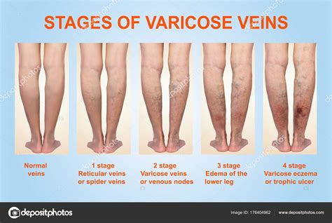 Varicose Veins On A Female Senior Leg — Stock Photo © Marina113 176404962