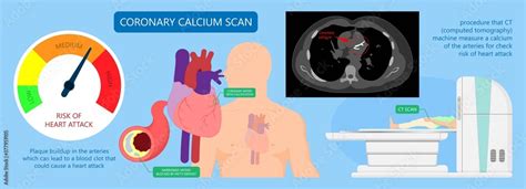 Cardiac Calcium Scoring Chest Health Signs X Ray Block Treat Blood