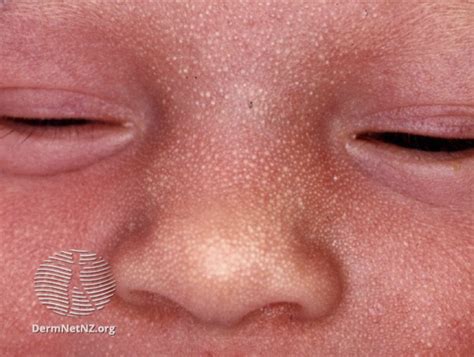 Rashes In Newborns Making Sense Of The Dots And Spots — Maternity Matters
