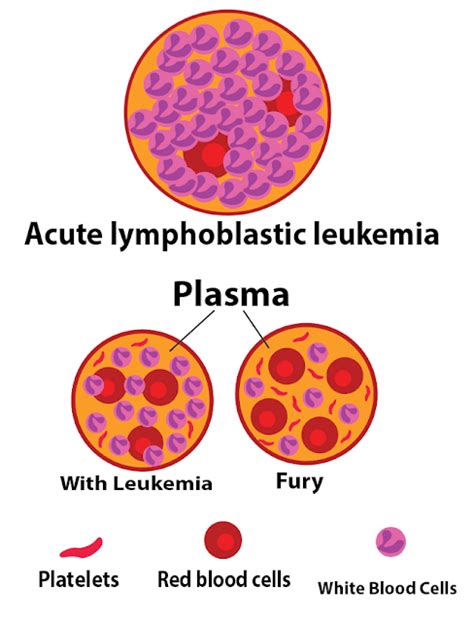 Acute Lymphoblastic Leukemia Bforhcom
