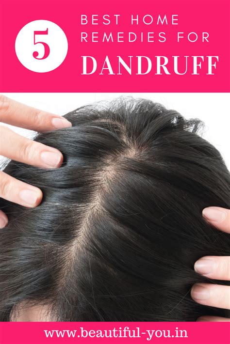 How To Remove Dandruff 5 Dandruff Home Remedies Dandruff Remedy