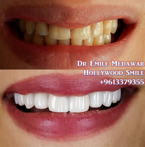 But it comes with the responsibility of selecting, monitoring and deciding when to buy and sell those individual stocks. Direct Veneers | Emax Veneers Lebanon