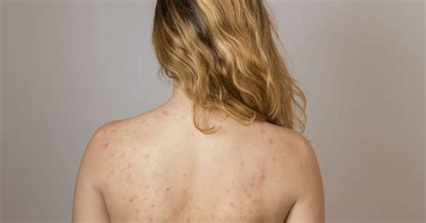 Back Acne Pimples The Cosmetic Clinic