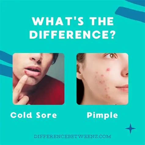 Difference Between Cold Sore And Pimple Difference Betweenz