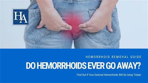 Do External Hemorrhoids Ever Go Away Find Out If Your External