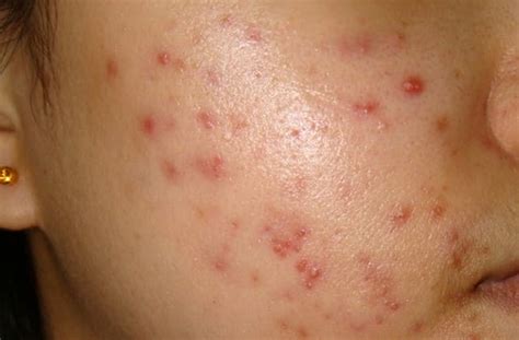 Munculnya bintik merah pada kulit bisa disebabkan oleh beberapa kondisi. Cara Menghilangkan Merah Di Muka Bekas Jerawat ...