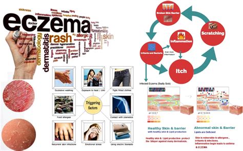 Here are 7 homeopathic remedies known to help treat eczema Eczema Online Homeopathic Treatment india Skin specialist ...