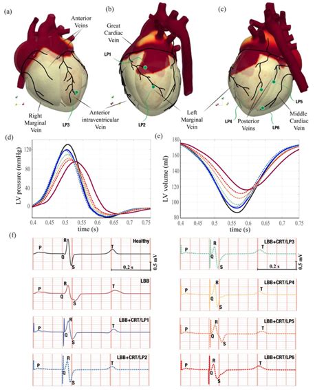 Optimal And Suboptimal Left Ventricular Pacing A C Views Of The