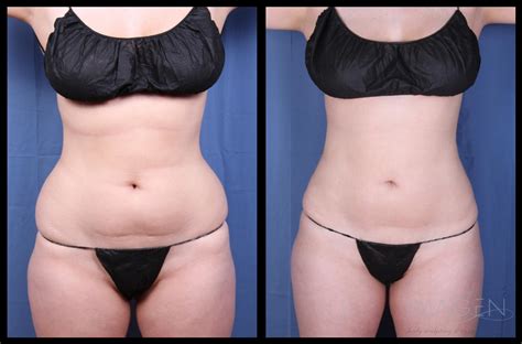SmartLipo Triplex Vs Traditional Liposuction Omaha Liposuction By Imagen