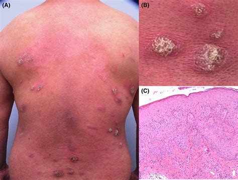 A Erythematous Scaly Plaques With Desquamation On The Back B