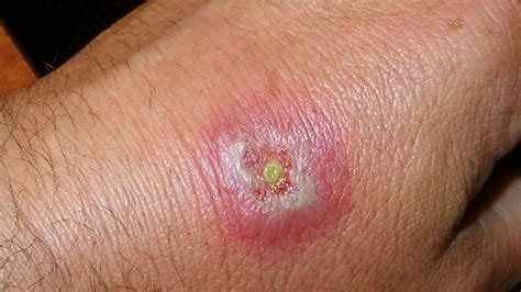 Diagnosis And Treatment Of Spider Bites New Star Pest Control Uae