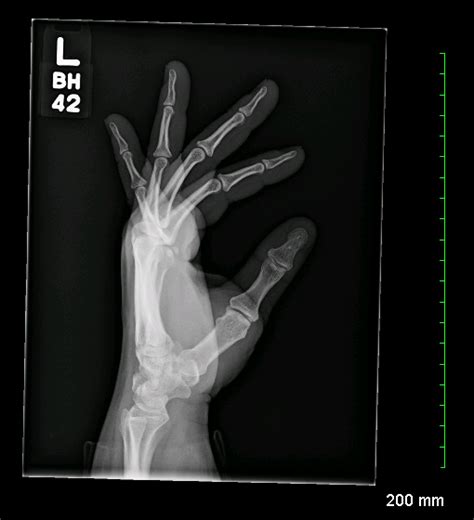 Left Hand X Ray