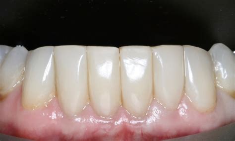 Black Triangle Teeth Treatment Bioclear In London Holland Park Dental