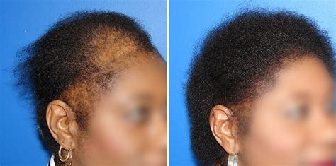 It ranges from normal hair density to a bald crown, which is rare. Hair Loss in African American Women: Traction Alopecia ...