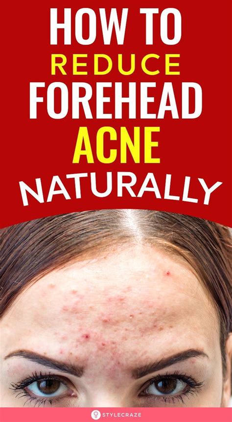 How To Get Rid Of Pimples On Forehead In 2021 Forehead Acne Pimples
