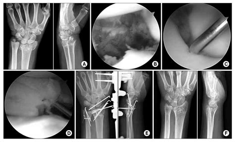 Management Of Comminuted Intra Articular Fractures Of The Distal Radius