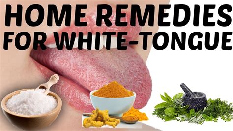Easy Home Remedies To Get Rid Of White Coated Tongue Youtube