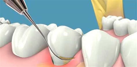 Curetaje Gingival Badía Clínica Dental