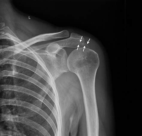 Calcific Tendonitis Of Supraspinatus Simulating Acute Brachial Neuritis