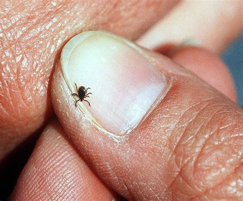 Upstate Lyme disease doctor: Early treatment crucial, but diagnosis can ...
