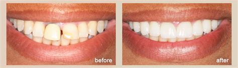 Porcelain Veneers In South New Jersey Advanced Cosmetic And General Dentistry