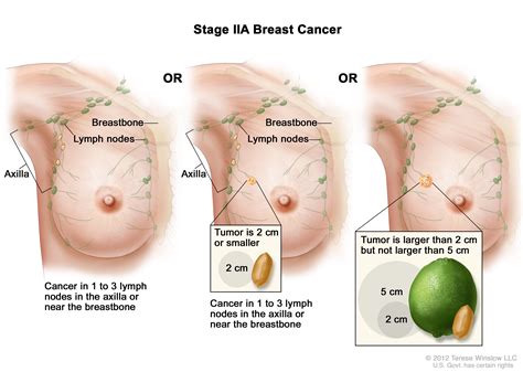 Changes in the size or shape of the breast Breast Cancer Treatment During Pregnancy (PDQ®) (Patients ...