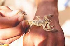 scorpion do sting when stung treatment symptoms hand surviving should healthline