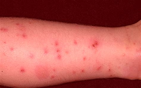 Flea Bites On Humans Symptoms Treatment Pictures Youmemindbody