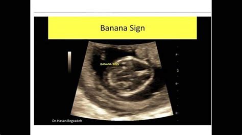 Banana Sign Tıp