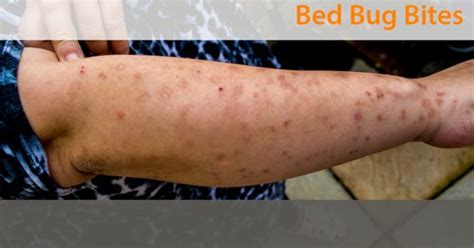 Severe Bed Bug Bites