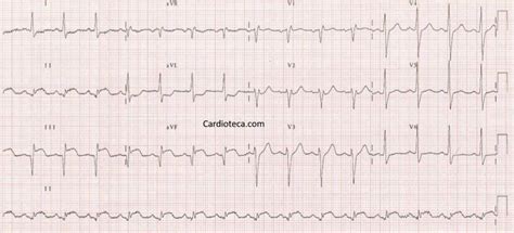 Curso Ecg Infarto Agudo De Miocardio De Cara Inferior Por Oclusi N De La Arteria Coronaria Derecha