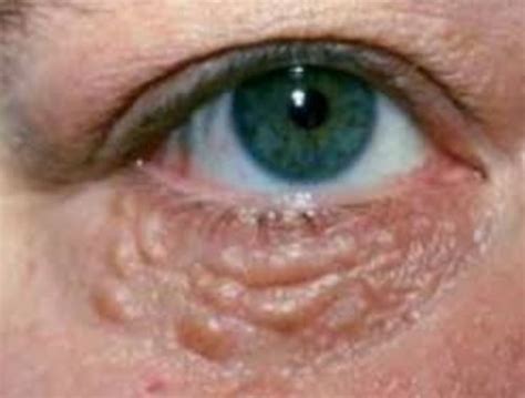 Bumps Under Eyes Meaning Milia Dots Causes Hard Cholesterol Dots