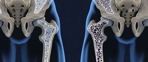 Osteoporosis Síntomas Causas Y Tratamiento Mdsaúde