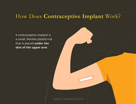Contraceptive Implants Radium Medical Aesthetics Singapore