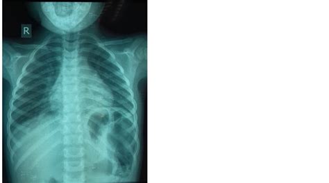 Secondary Spontaneous Rupture Of The Diaphragm In A Child After Blunt