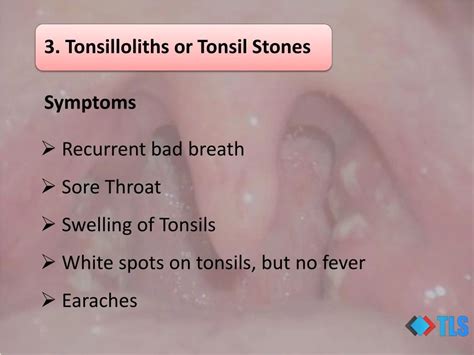 White Spots On Tonsils Causes
