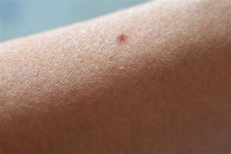 How To Remove Ingrown Arm Hair Livestrongcom