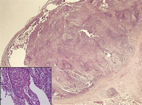 Primary Esophageal Mucosa Associated Lymphoid Tissue Lymphoma Treated