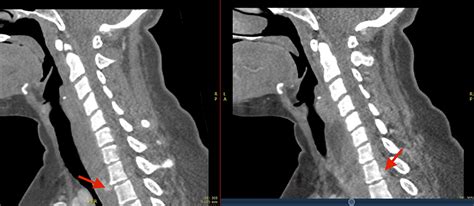 Cureus Traumatic Spinal Epidural Hematoma With Significant Neurologic