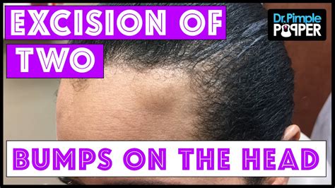 Surgical Removal Of Two Different Bumps On The Head Youtube