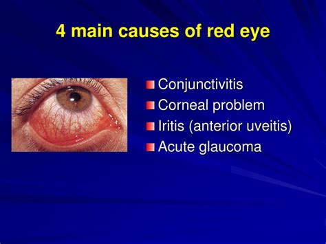 Ppt 4 Main Causes Of Red Eye Powerpoint Presentation Free Download